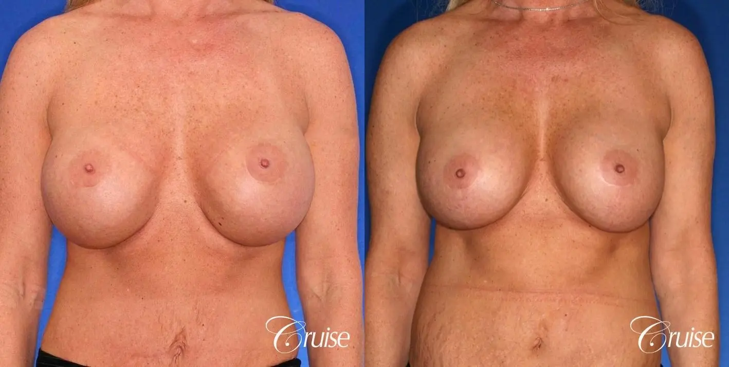 best correction of bottomed out implants revision surgery - Before and After 1