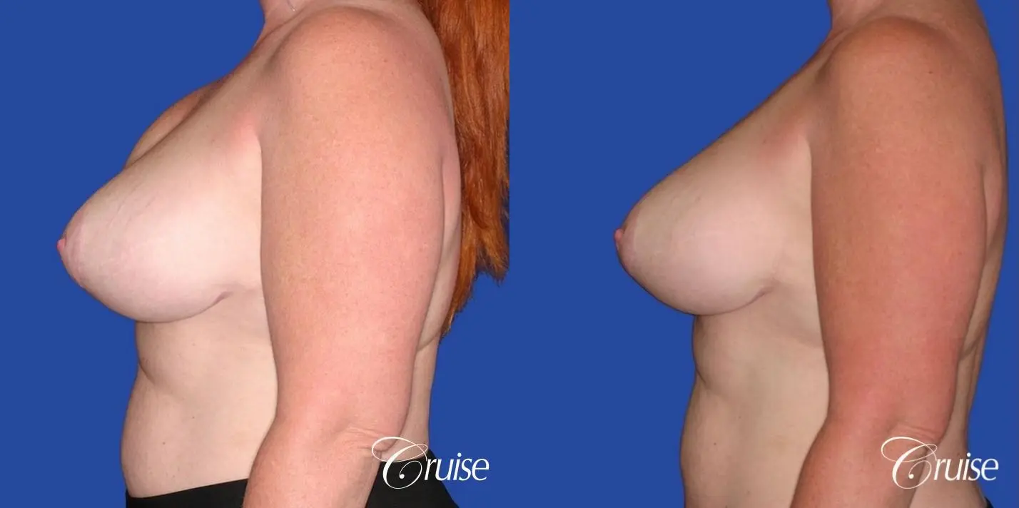 capsular contracture before and after pictures in Newport Beach - Before and After 2