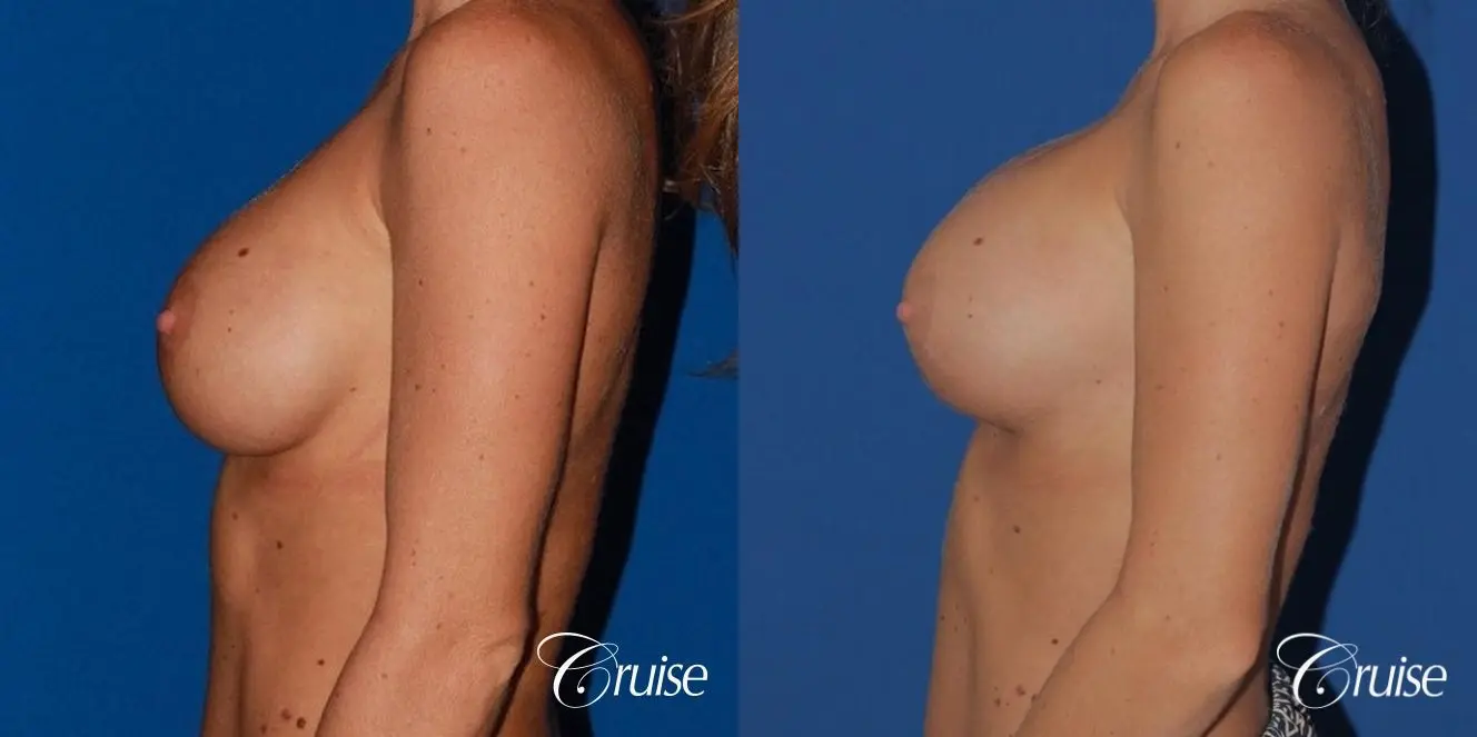 breast reconstruction better cleavage and capsulectomy - Before and After 2