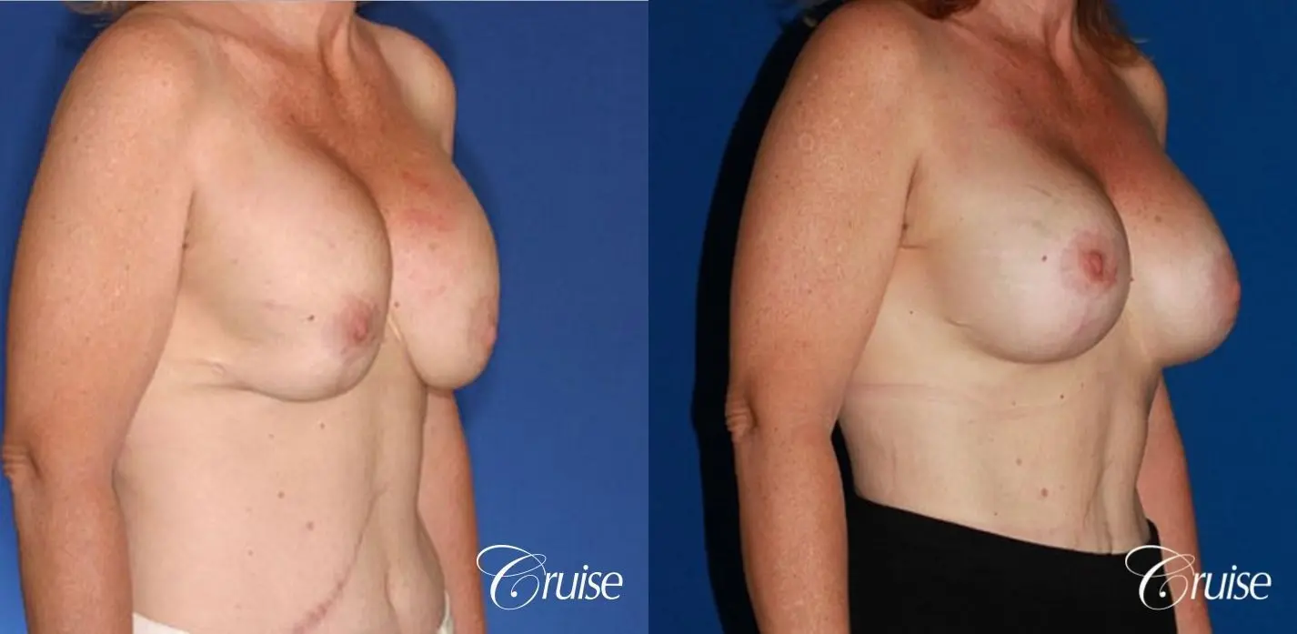 bilateral capsular contracture silicone - Before and After 3