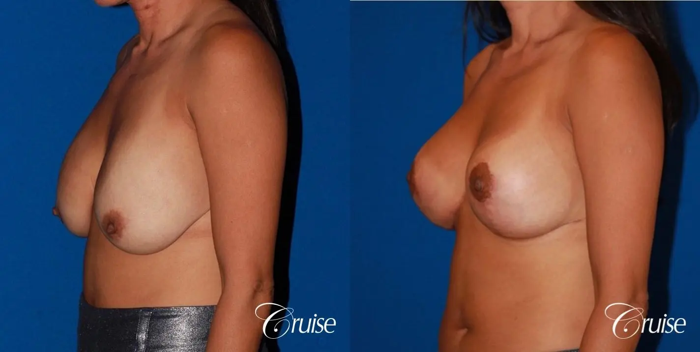 unhappy with her shape she had a breast revsion and lift - Before and After 2
