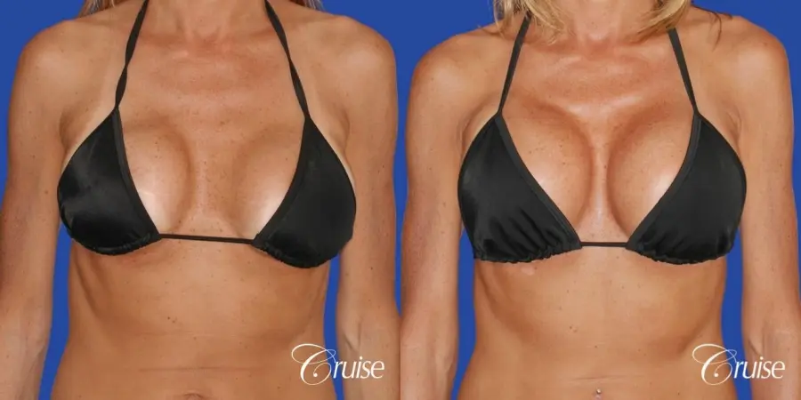 best breast revision for better cleavage and shape - Before and After 4