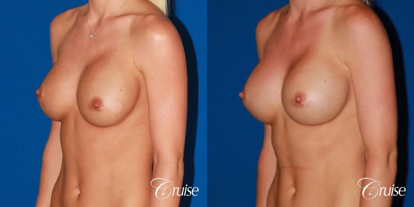 breast revision with best results for breast asymmetries - Before and After 3