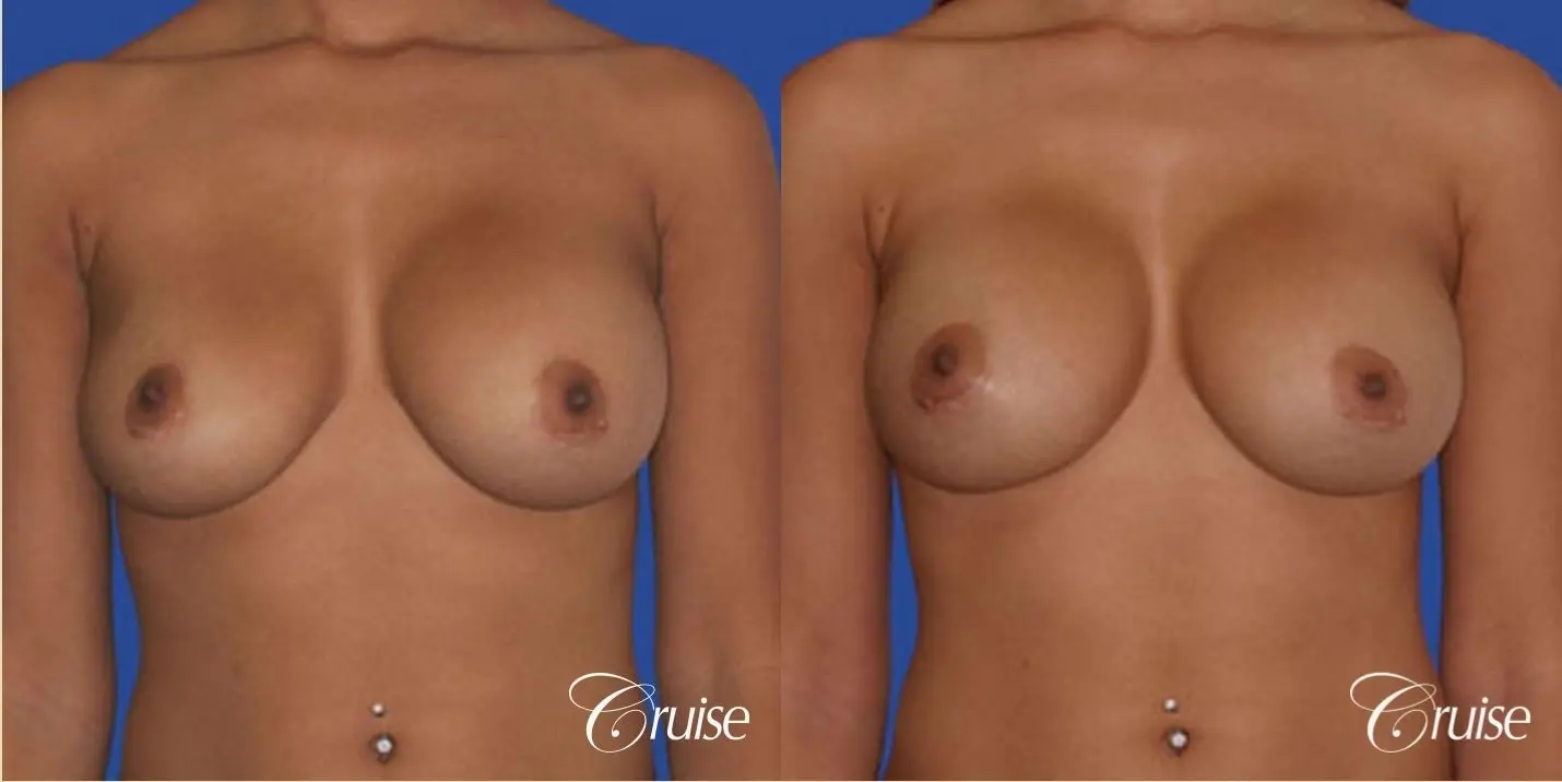 best pictures of ruptured implant breast revision - Before and After 1