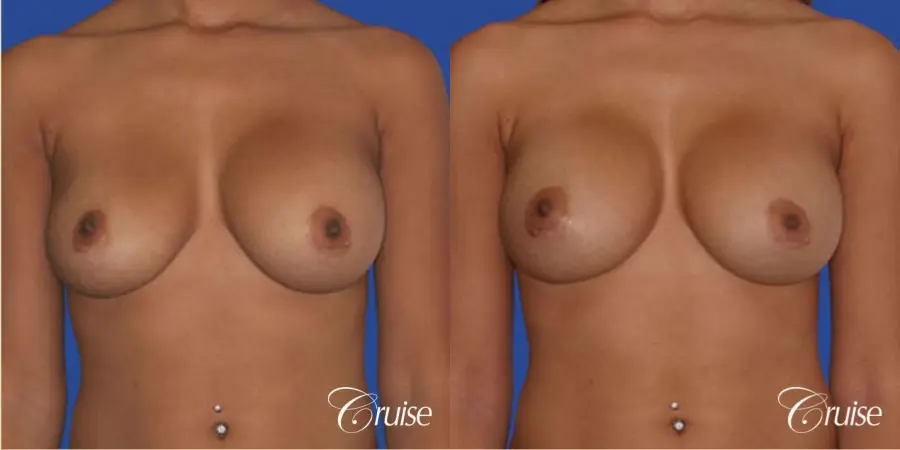 best pictures of ruptured implant breast revision - Before and After