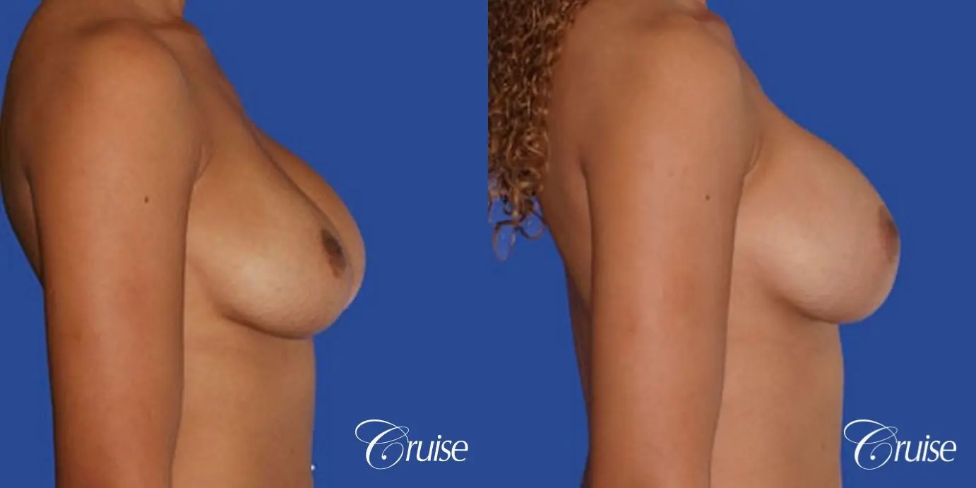 best pictures of ruptured implant breast revision - Before and After 2