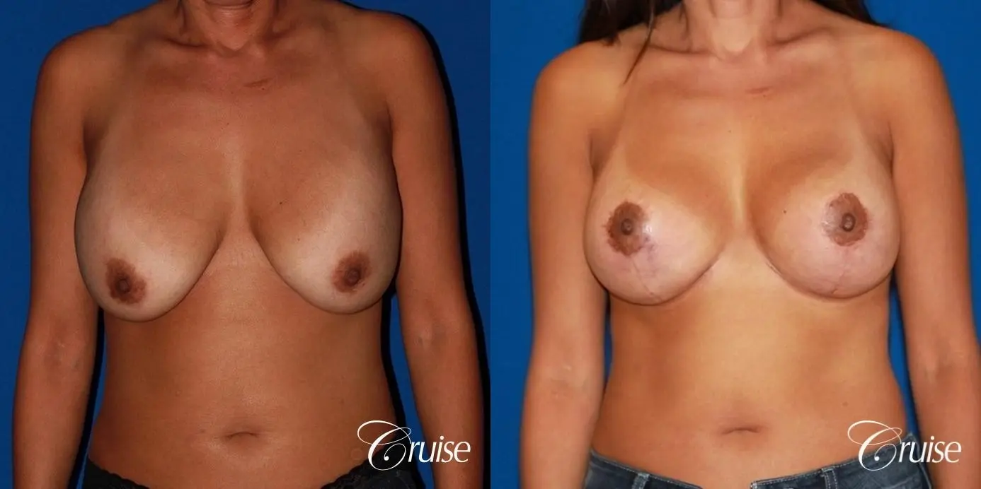 unhappy with her shape she had a breast revsion and lift - Before and After