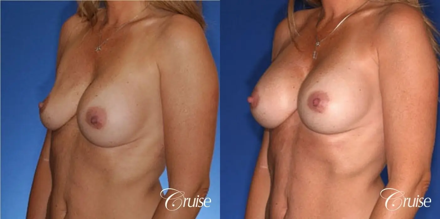 best revision on a saline breast implant rupture - Before and After 2