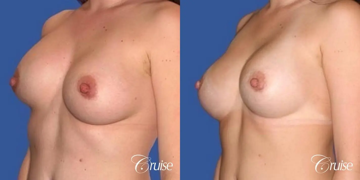 best surgeon for breast revision capsular contracture - Before and After 3