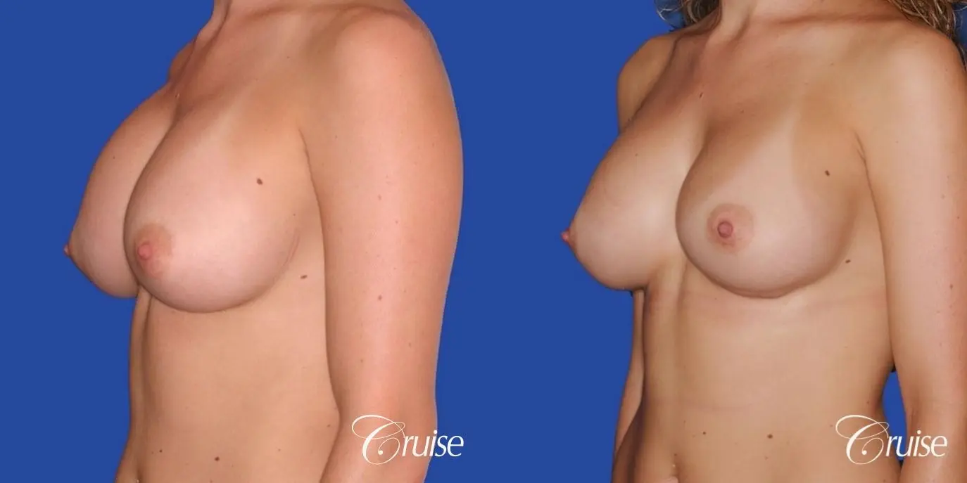 best pictures of breast revision for capsular contracture - Before and After 1