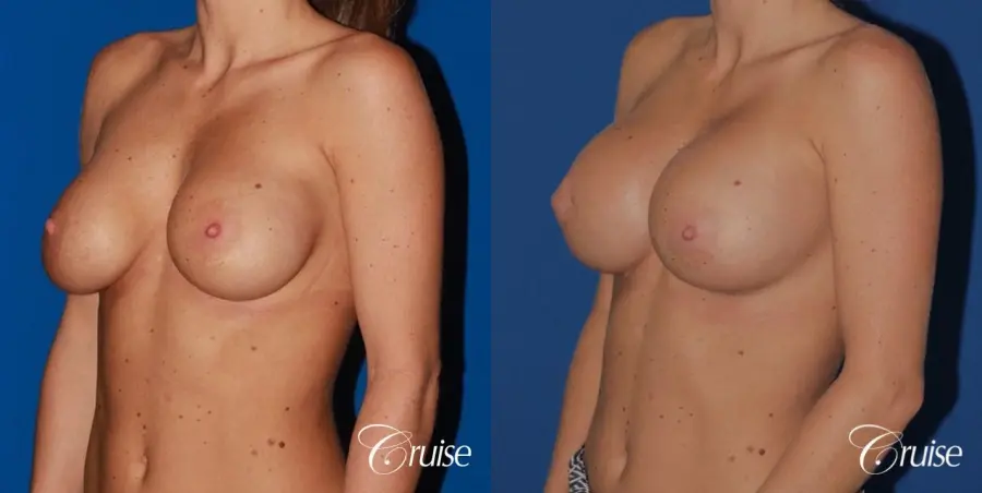 breast reconstruction better cleavage and capsulectomy - Before and After 3