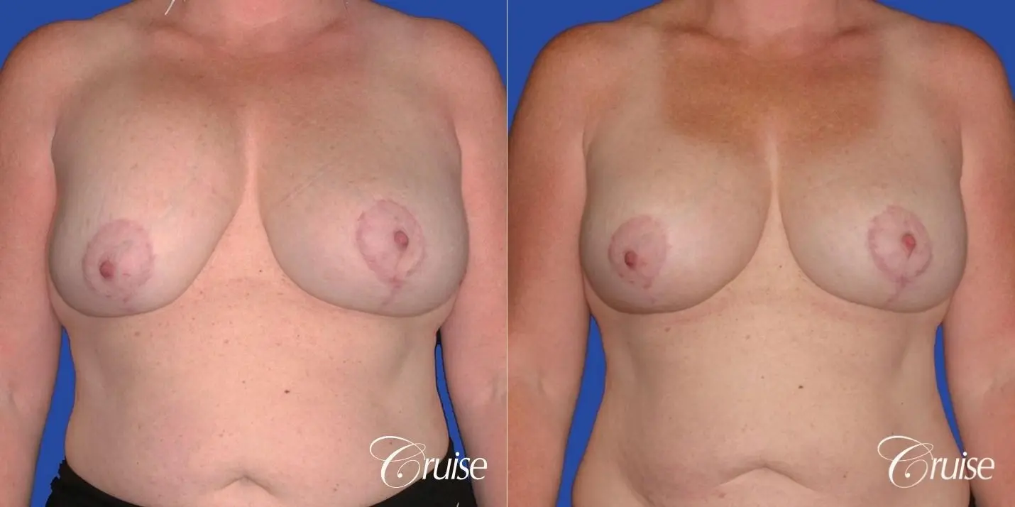 capsular contracture before and after pictures in Newport Beach - Before and After 1