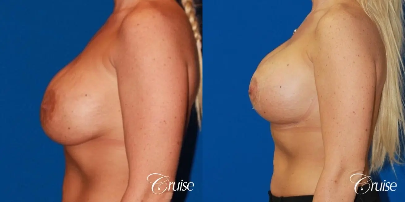 best breast revision to lift low implants - Before and After 2