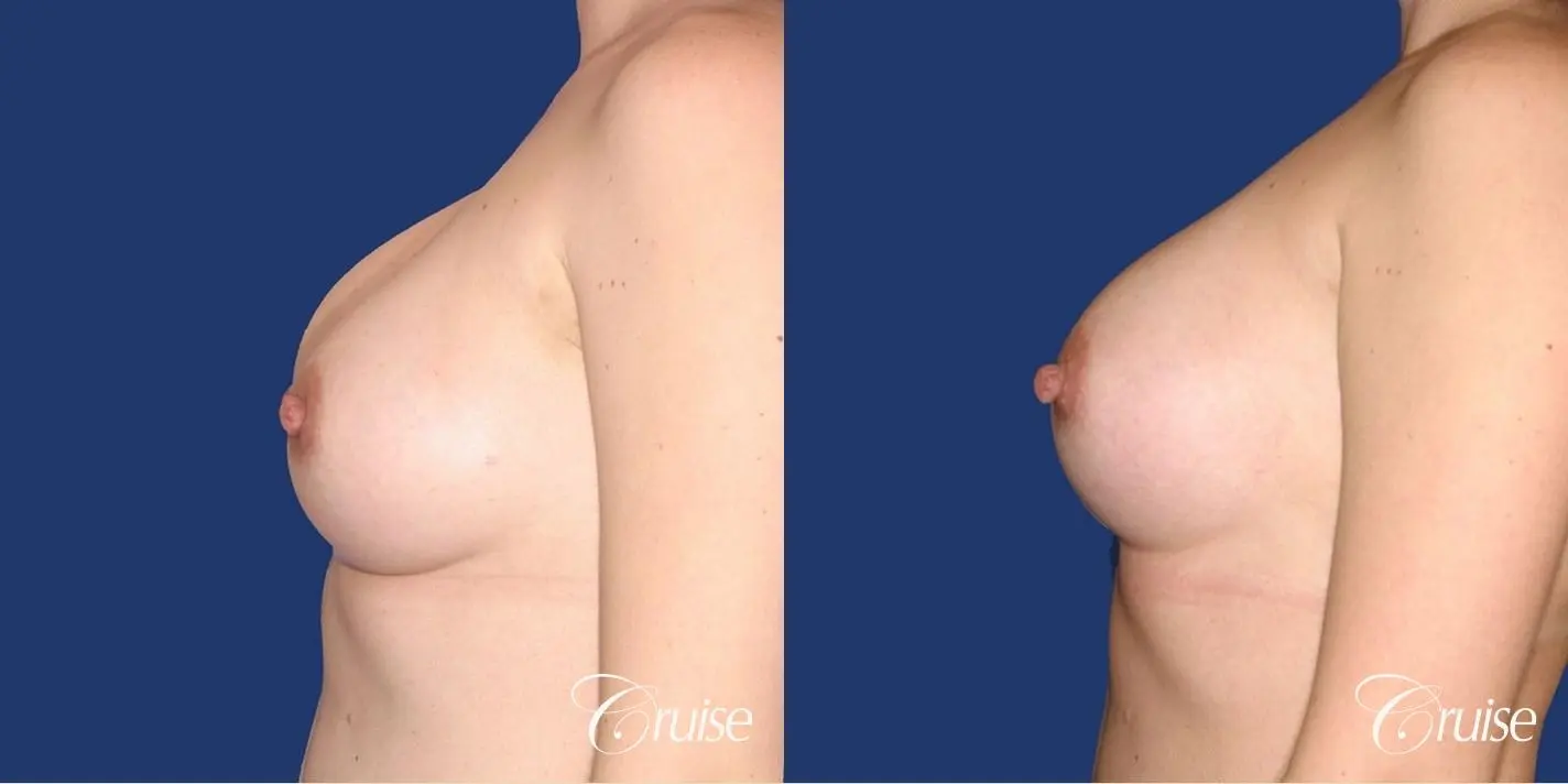 best surgeon for breast revision capsular contracture - Before and After 2