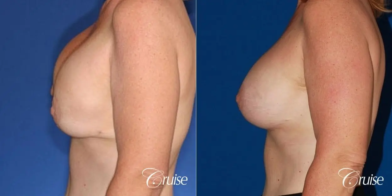 bilateral capsular contracture silicone - Before and After 2