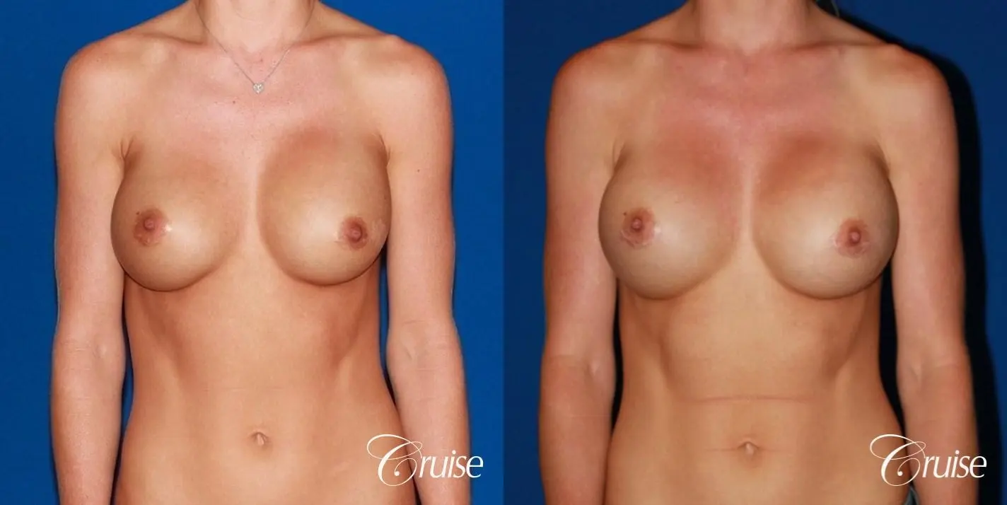 breast revision with best results for breast asymmetries - Before and After 1