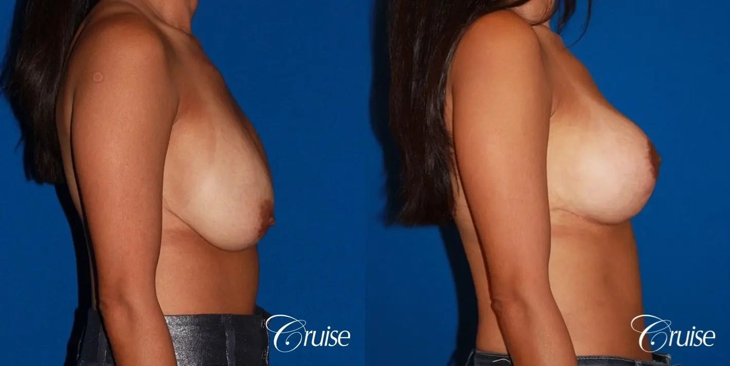 unhappy with her shape she had a breast revsion and lift - Before and After 3