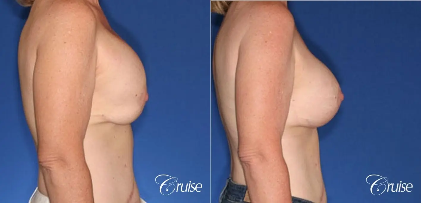 bilateral capsular contracture silicone - Before and After 4