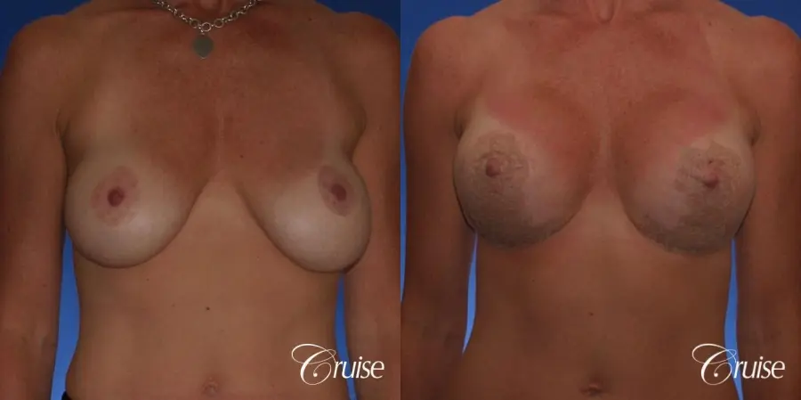 Best breast revision for low implants - Before and After