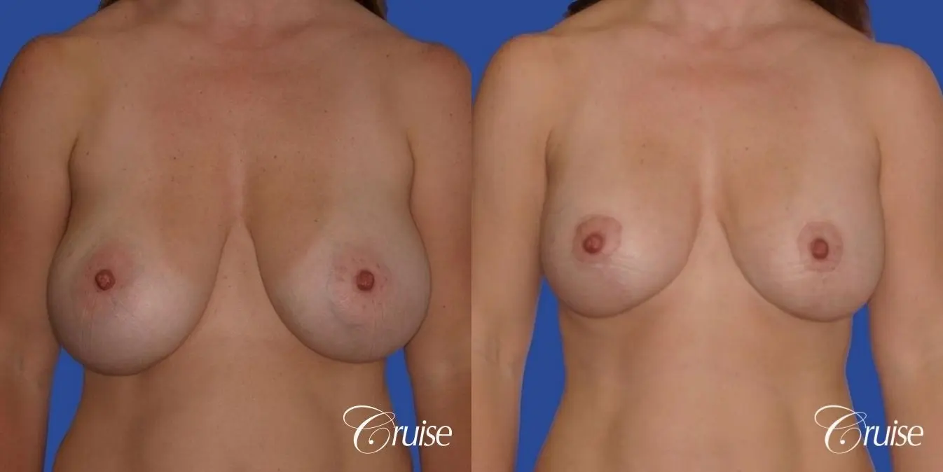 best revision to correct large breast - Before and After 1