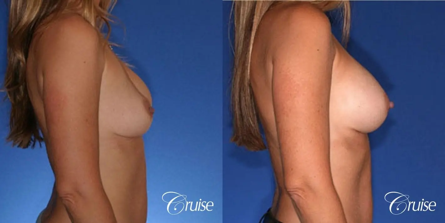 best revision on a saline breast implant rupture - Before and After 5