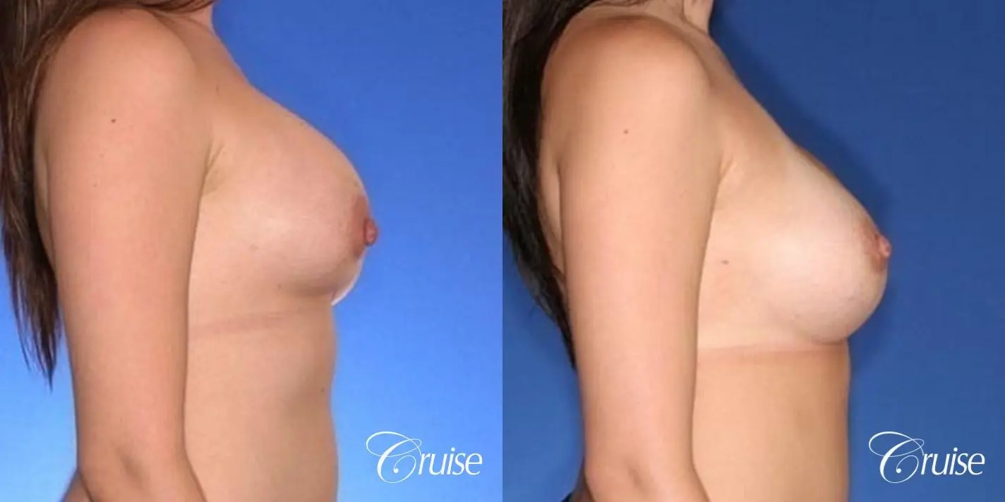 best surgeon for breast revision capsular contracture - Before and After 4