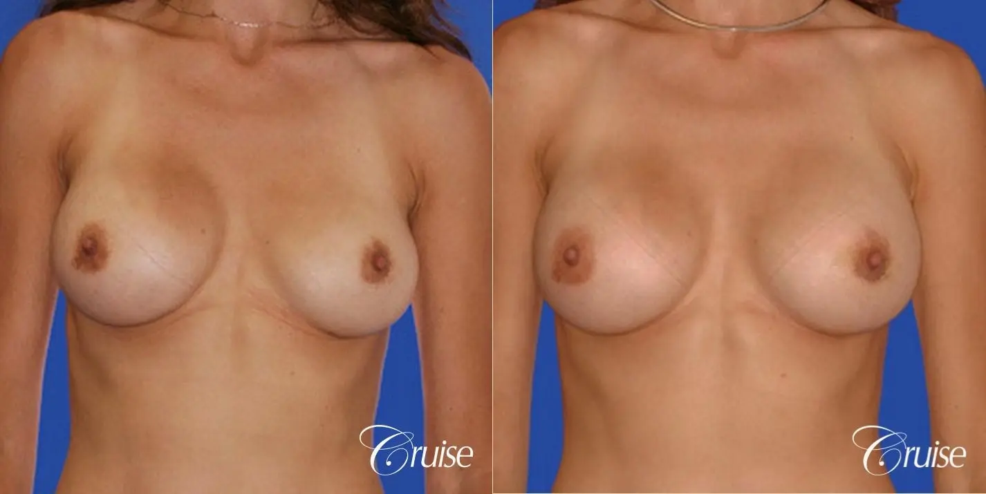best pictures of breast implant rupture saline - Before and After 1