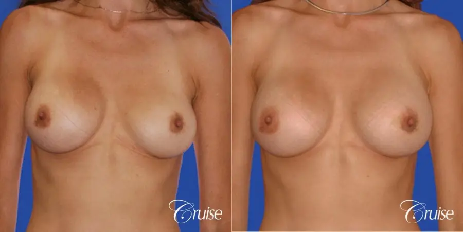 best pictures of breast implant rupture saline - Before and After