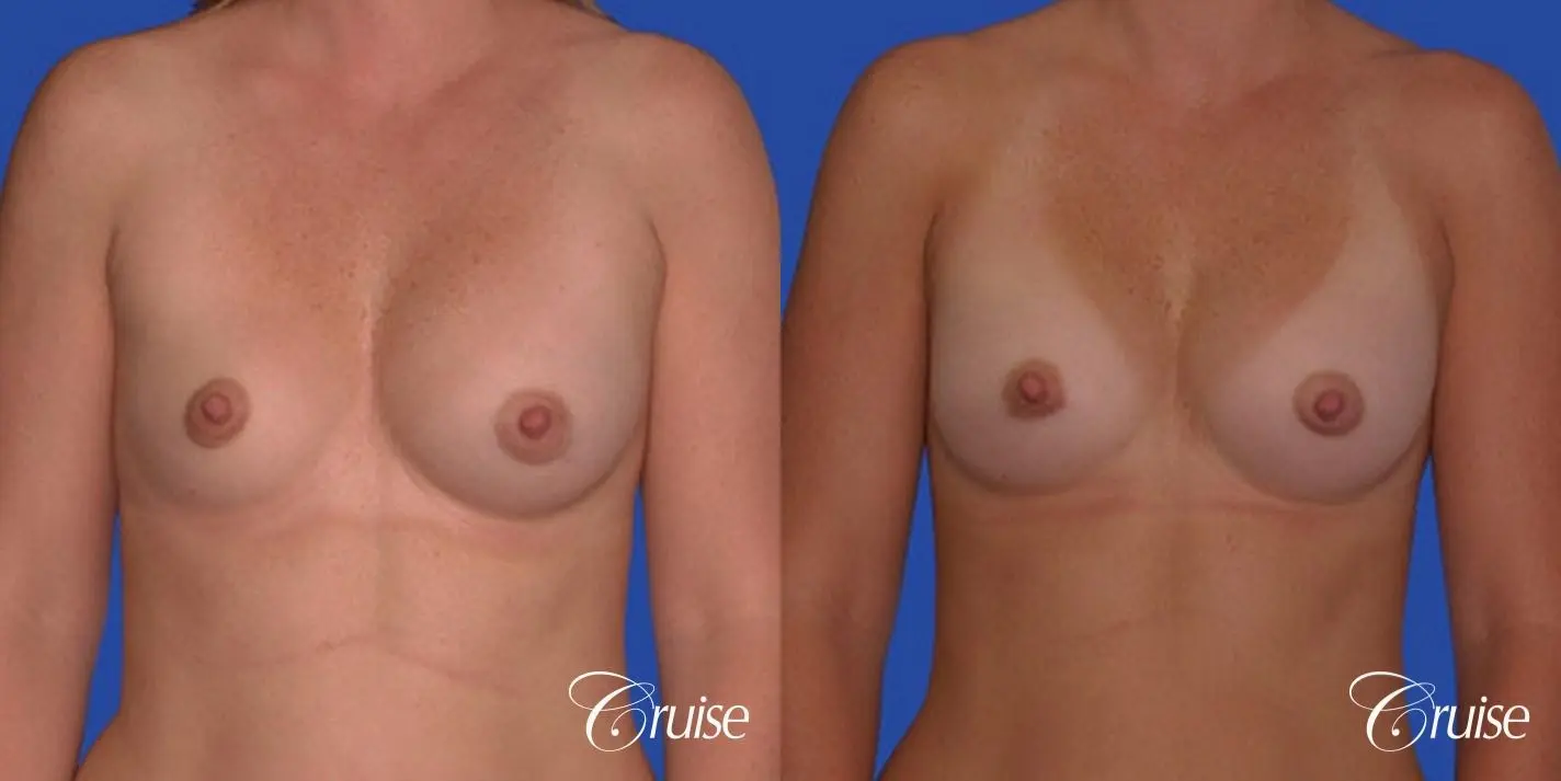 saline implant rupture newport beach plastic surgeon - Before and After 1
