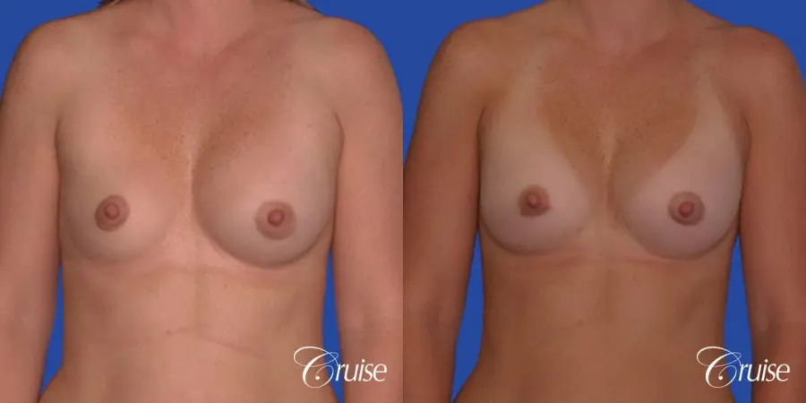 saline implant rupture newport beach plastic surgeon - Before and After