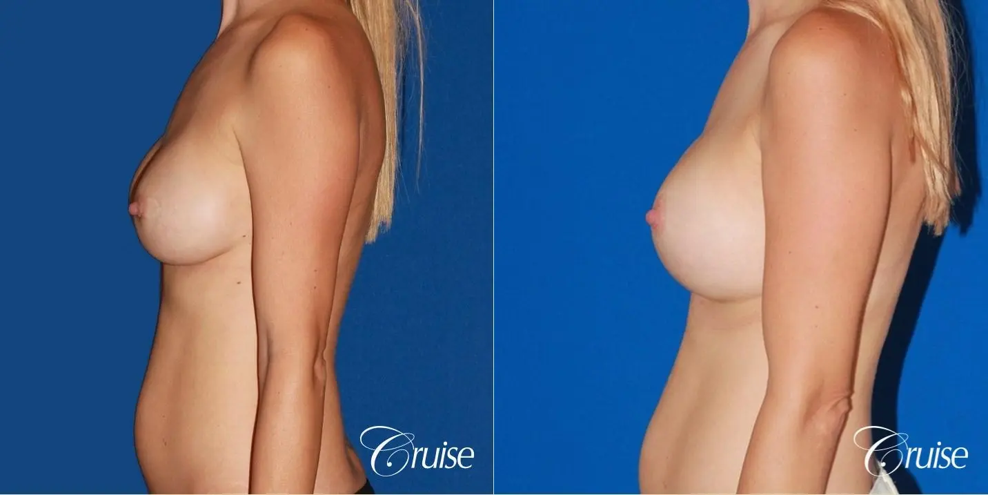 best breast revision for closer cleavage - Before and After 2
