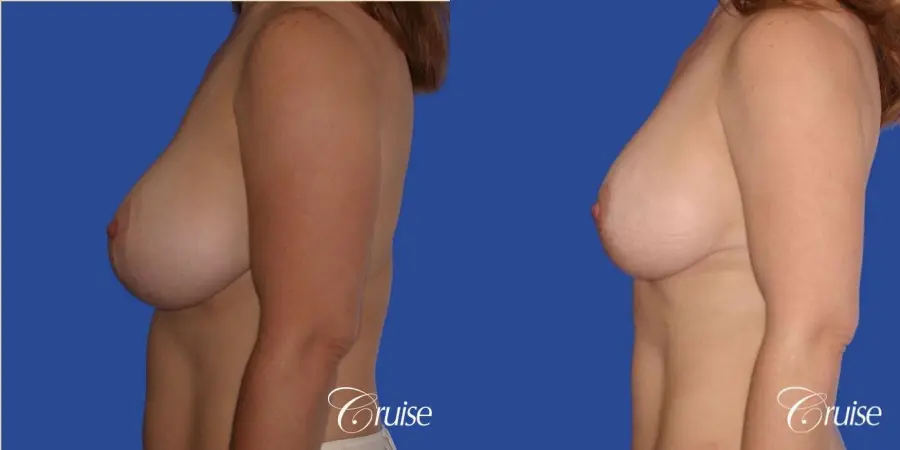 best revision to correct large breast - Before and After 2