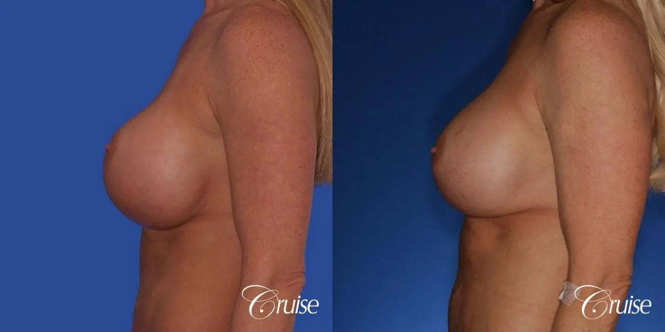 best correction of bottomed out implants revision surgery - Before and After 2