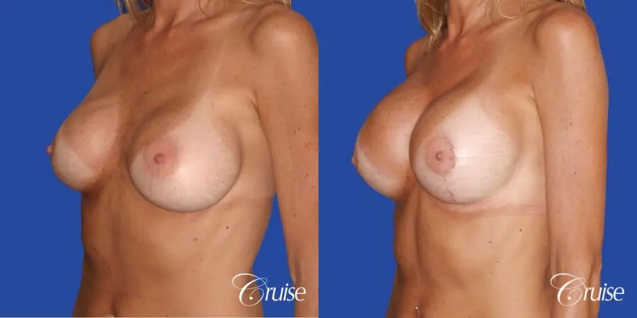 best breast revision for better cleavage and shape - Before and After 3