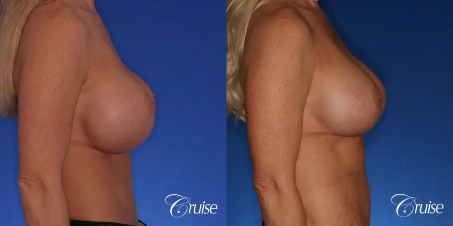best correction of bottomed out implants revision surgery - Before and After 3