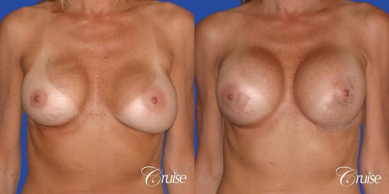 best breast revision for better cleavage and shape - Before and After