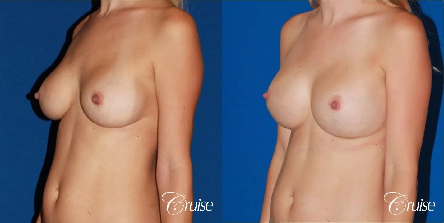 best breast revision for closer cleavage - Before and After 3