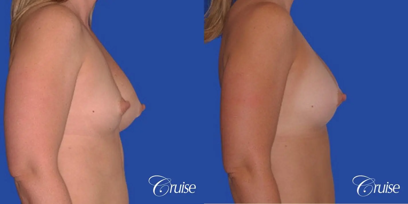 saline implant rupture newport beach plastic surgeon - Before and After 2