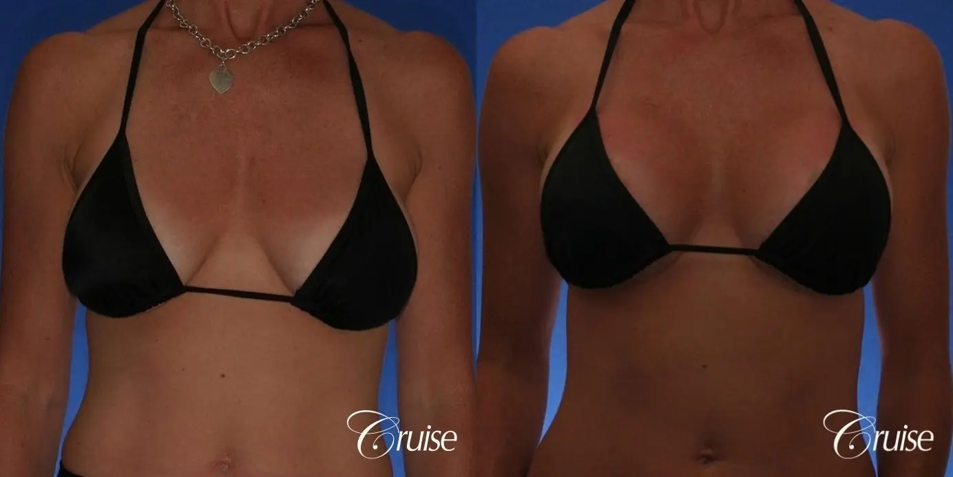 Best breast revision for low implants - Before and After 4