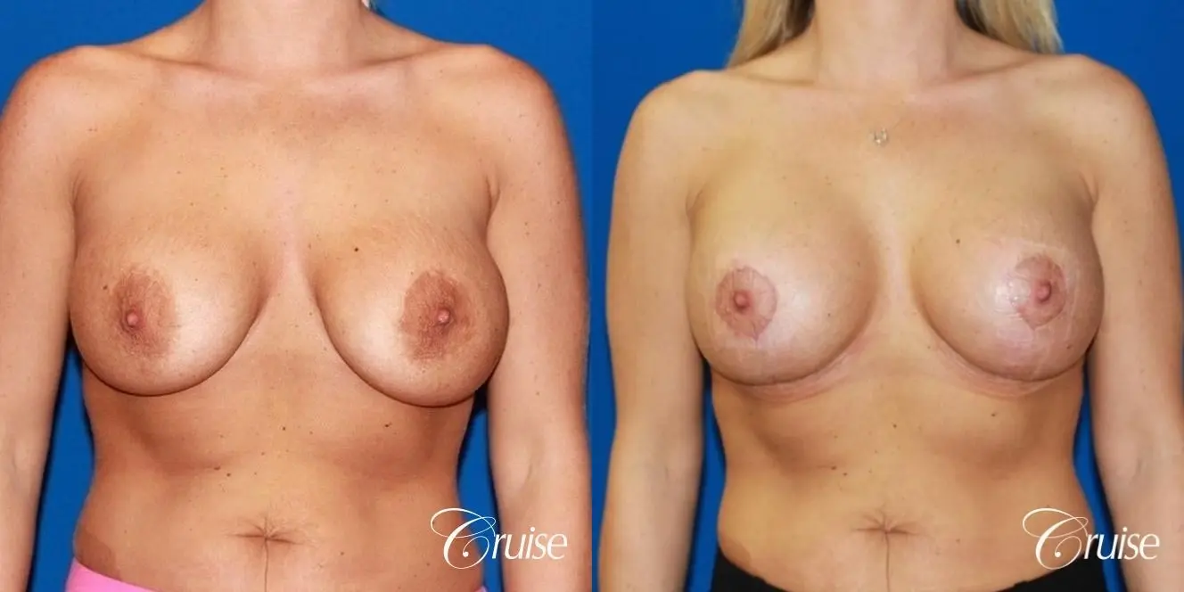 best breast revision to lift low implants - Before and After 1