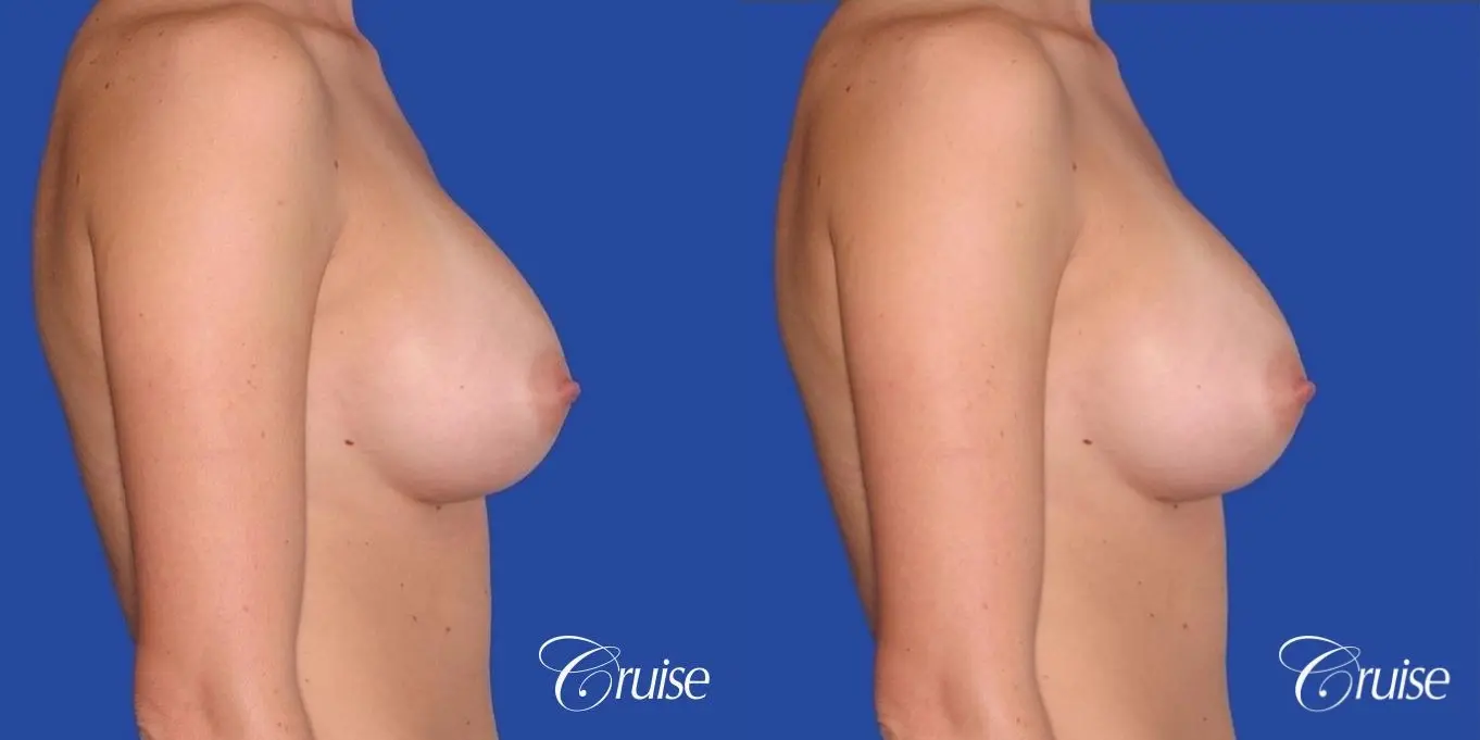 best pictures of breast revision for capsular contracture - Before and After 2