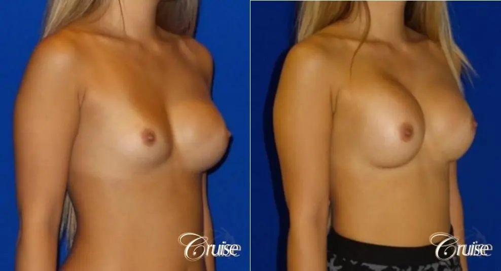 Breast Revision - Before and After 2