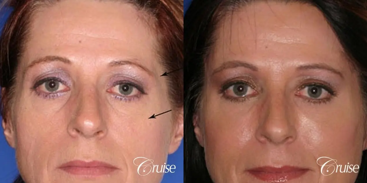 best temple lift facial rejuvenation to brighten eyes - Before and After 1
