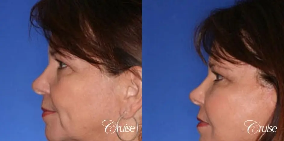 temple lift with face lift patient - Before and After 2