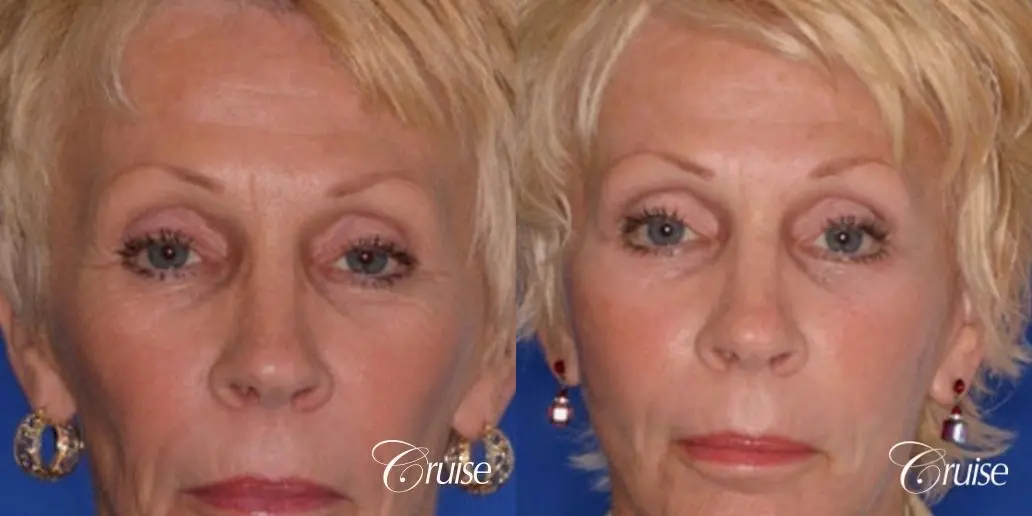 female with the best scars on a brow lift - Before and After 1