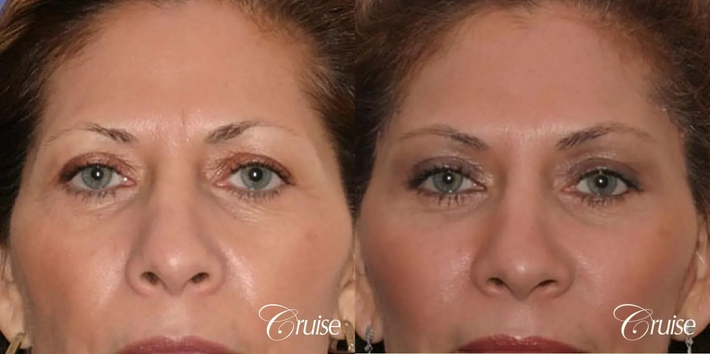 best woman temple lift scars Newport Beach - Before and After 1