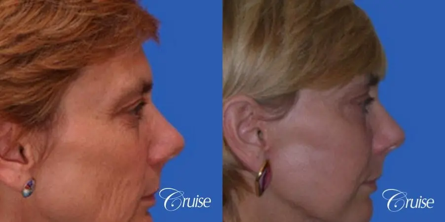 best neck and temple lift on female patient - Before and After 3