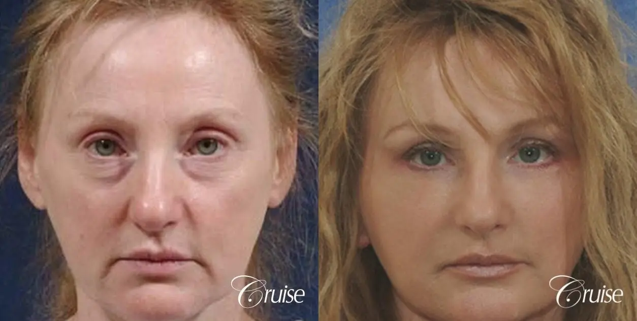 female with brow lift surgery before and after pictures - Before and After 1