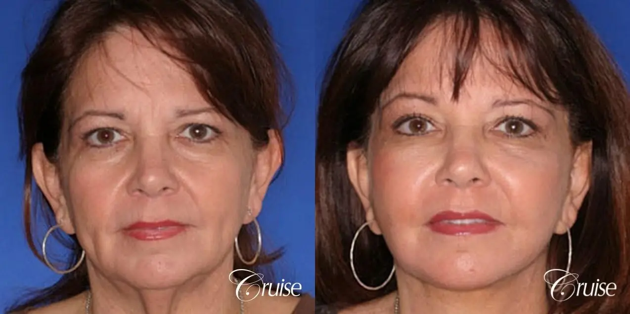 temple lift with face lift patient - Before and After 1