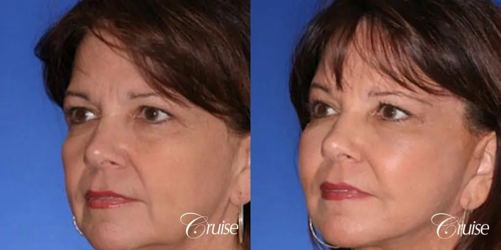 temple lift with face lift patient - Before and After 3